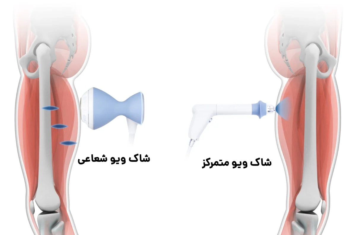 انواع شاک ویو تراپی