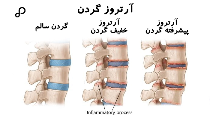 آرتروز گردن