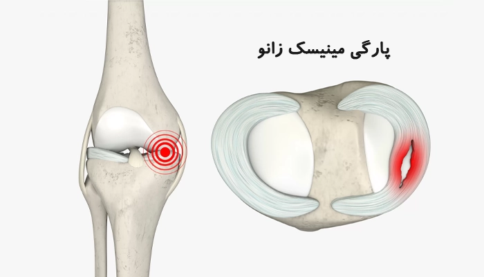 پارگی مینیسک